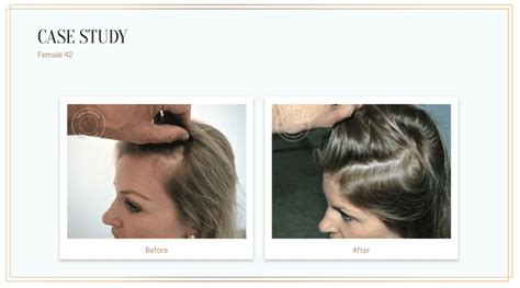 I Tried Harklinikken, the Buzzy Scandinavian Hair .
